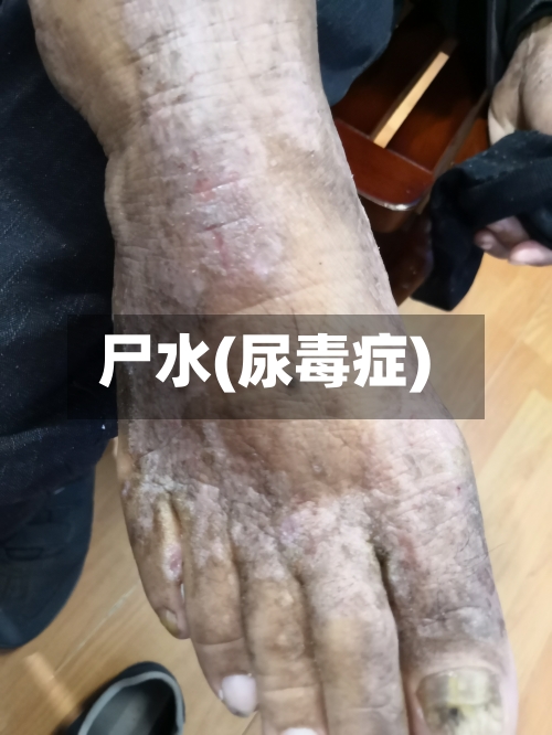 尸水(尿毒症)-第1张图片